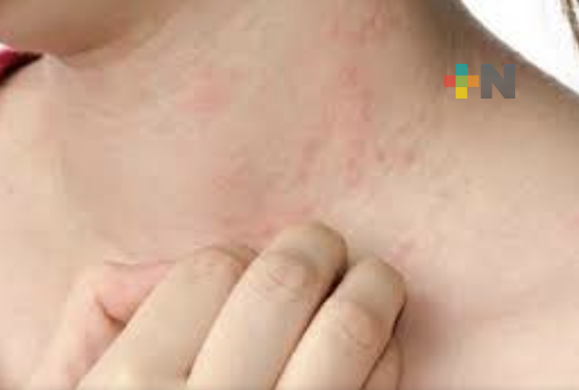 Dermatóloga explica afectaciones que causan los rayos solares en la piel